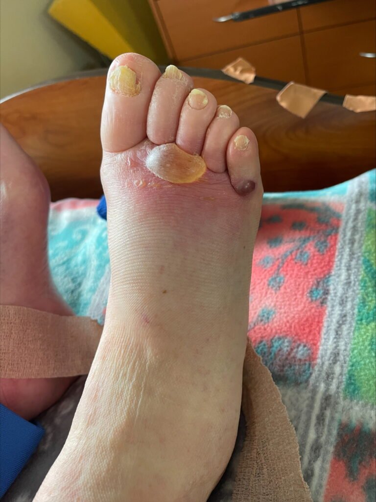 lymphatic blister