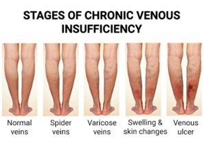 Chronic Venous Insufficiency (CVI) and Lower Body Swelling