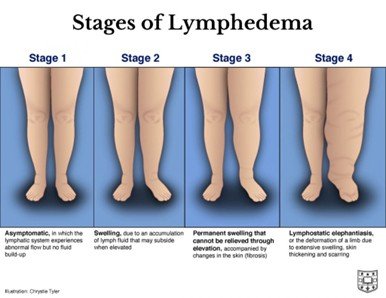 Lymphedema or Edema? Key Signs to Know